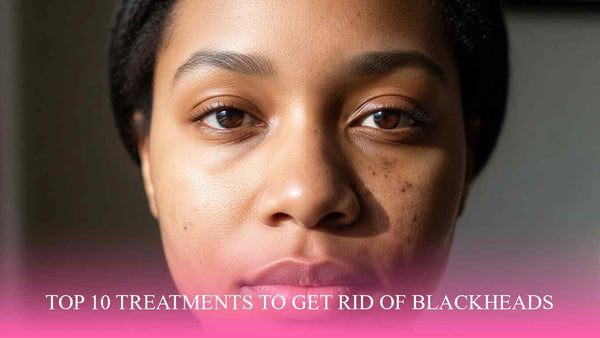 Top Treatments to Get Rid of Blackheads - EOB Website
