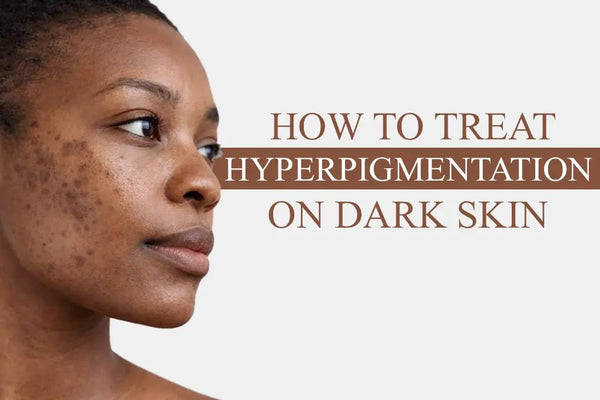 How to Treat Hyperpigmentation on Dark Skin: What Actually Works - EOB Website